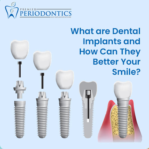 What are Dental Implants and How Can They Better Your Smile?