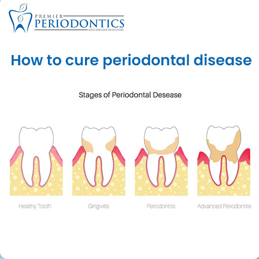 how to cure periodontal disease