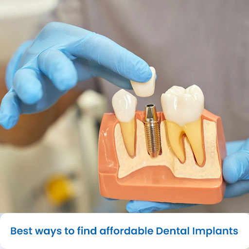 Best ways to find affordable dental implants