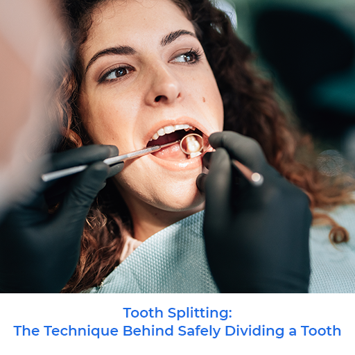 Tooth Splitting: The Technique Behind Safely Dividing a Tooth