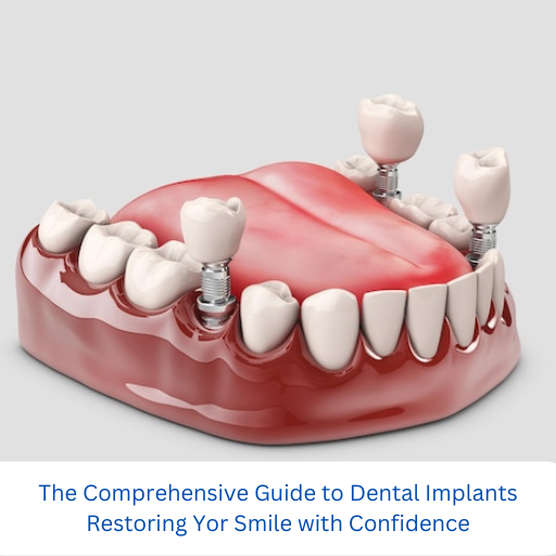 The Comprehensive Guide to Dental Implants: Restoring Your Smile with Confidence