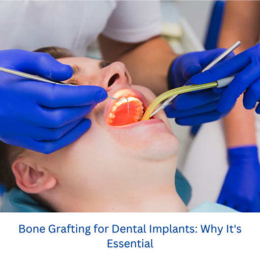 Bone Grafting for Dental Implants: Why It’s Essential