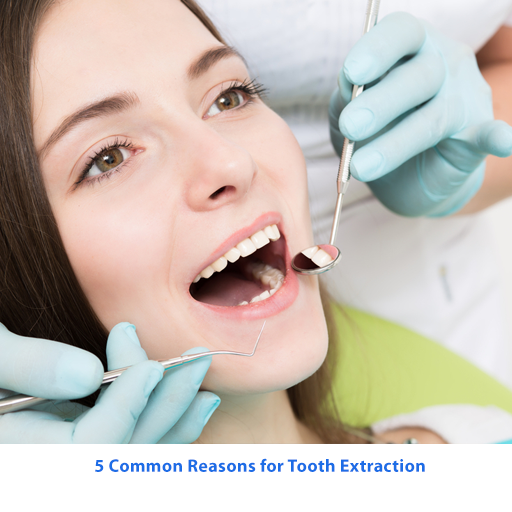 5 Common Reasons for Tooth Extraction