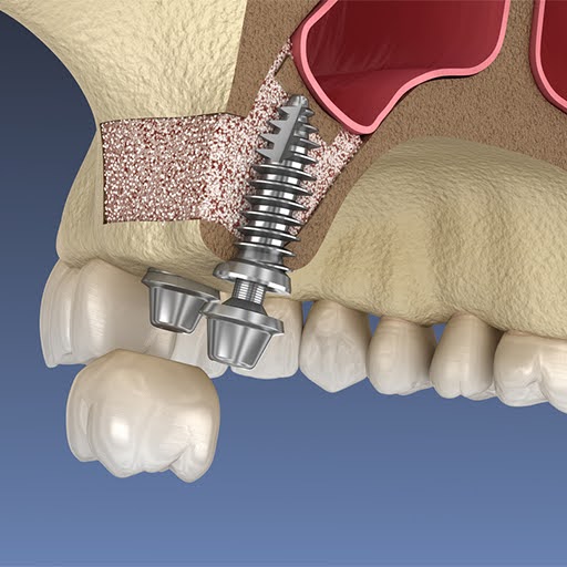 Types of Sinus Lifting Techniques