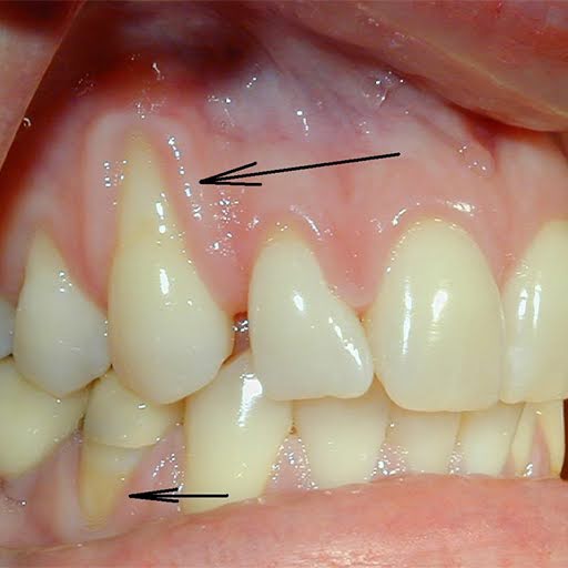 Promotion of Gingival Maturation