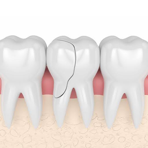 Cracked or Broken Teeth The Unexpected Emergency