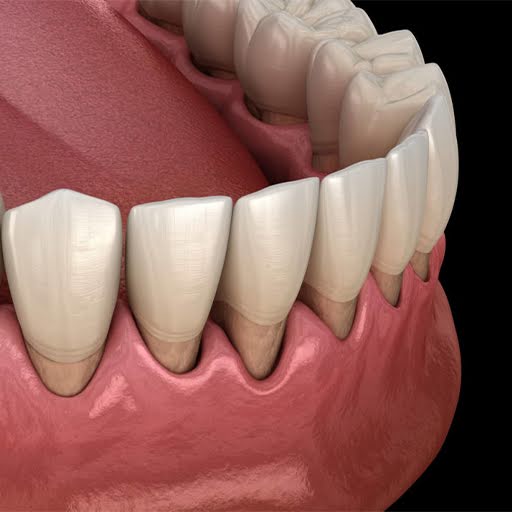 . Gum Disease The Hidden Threat