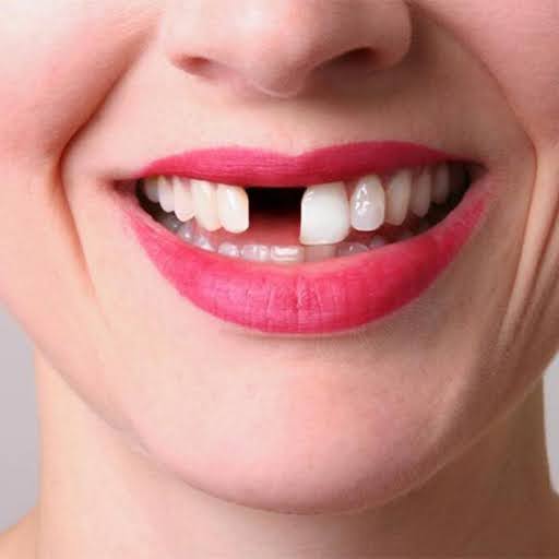 Prevention of Tooth Loss Keeping Your Smile Intact