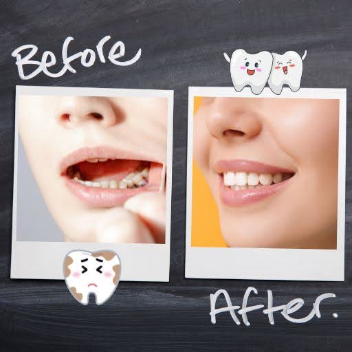 Restore-Your-Smile-with-Gum-Grafting-5