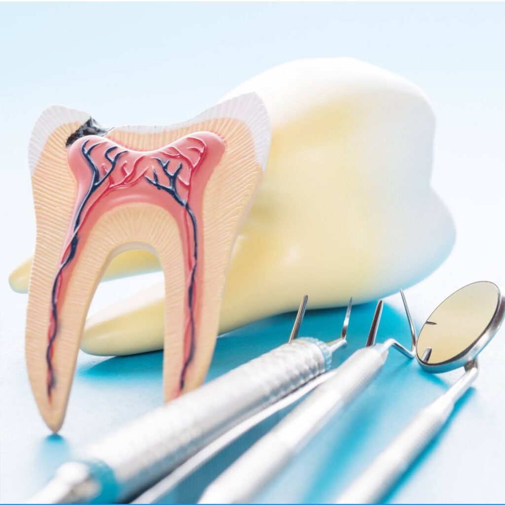 Root-Canals-What-to-Expect-Before-During-and-After-1