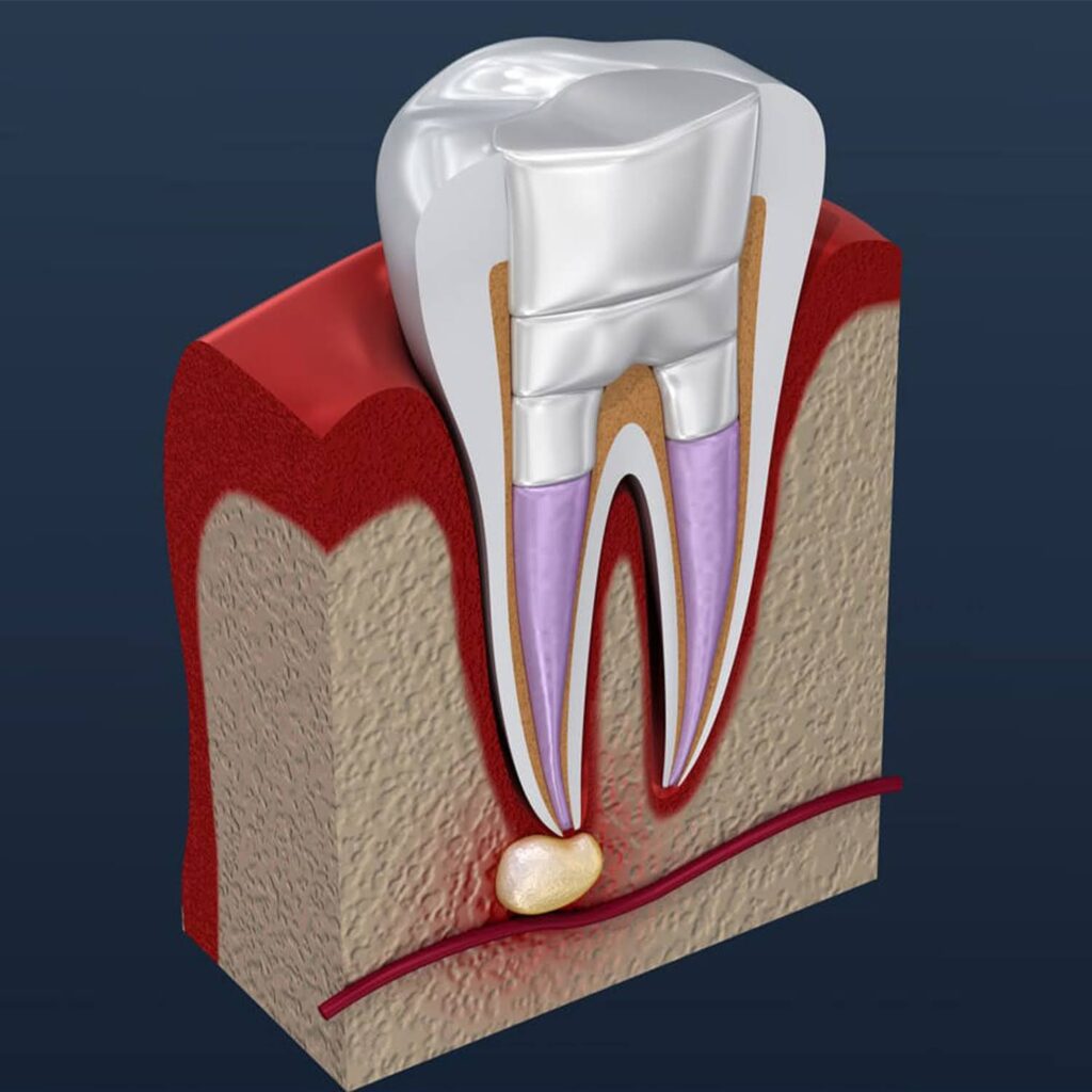 Root-Canals-What-to-Expect-Before-During-and-After-2