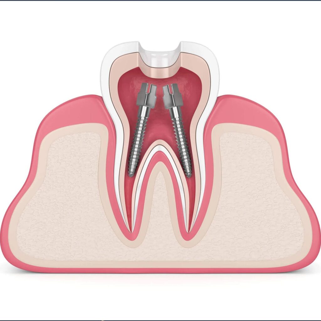 Root-Canals-What-to-Expect-Before-During-and-After-3