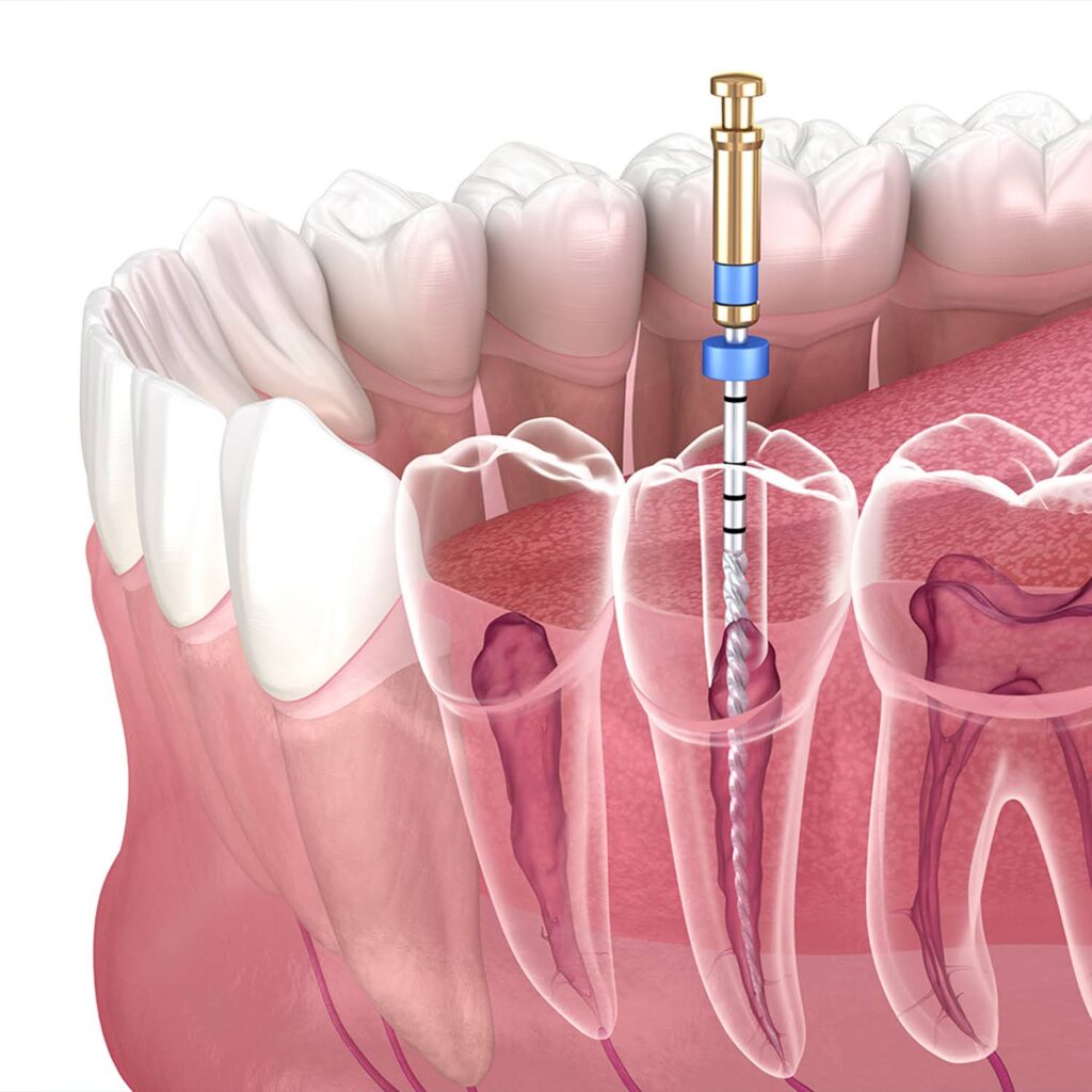 Root-Canals-What-to-Expect-Before-During-and-After-5