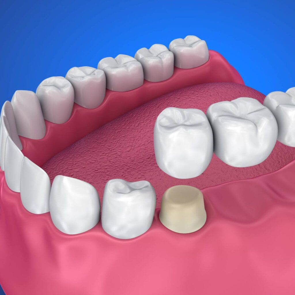 Root-Canals-What-to-Expect-Before-During-and-After-7