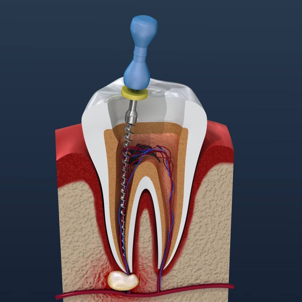 Root-Canals-What-to-Expect-Before-During-and-After-8