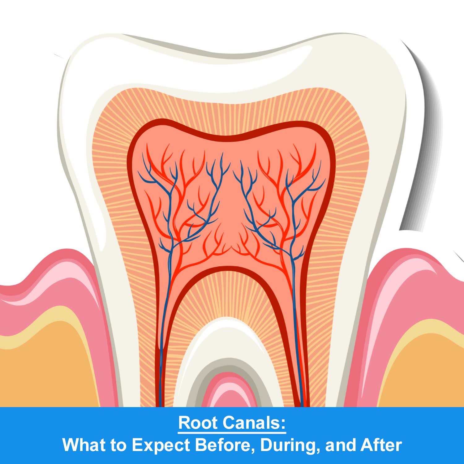 Root-Canals-What-to-Expect-Before-During-and-After