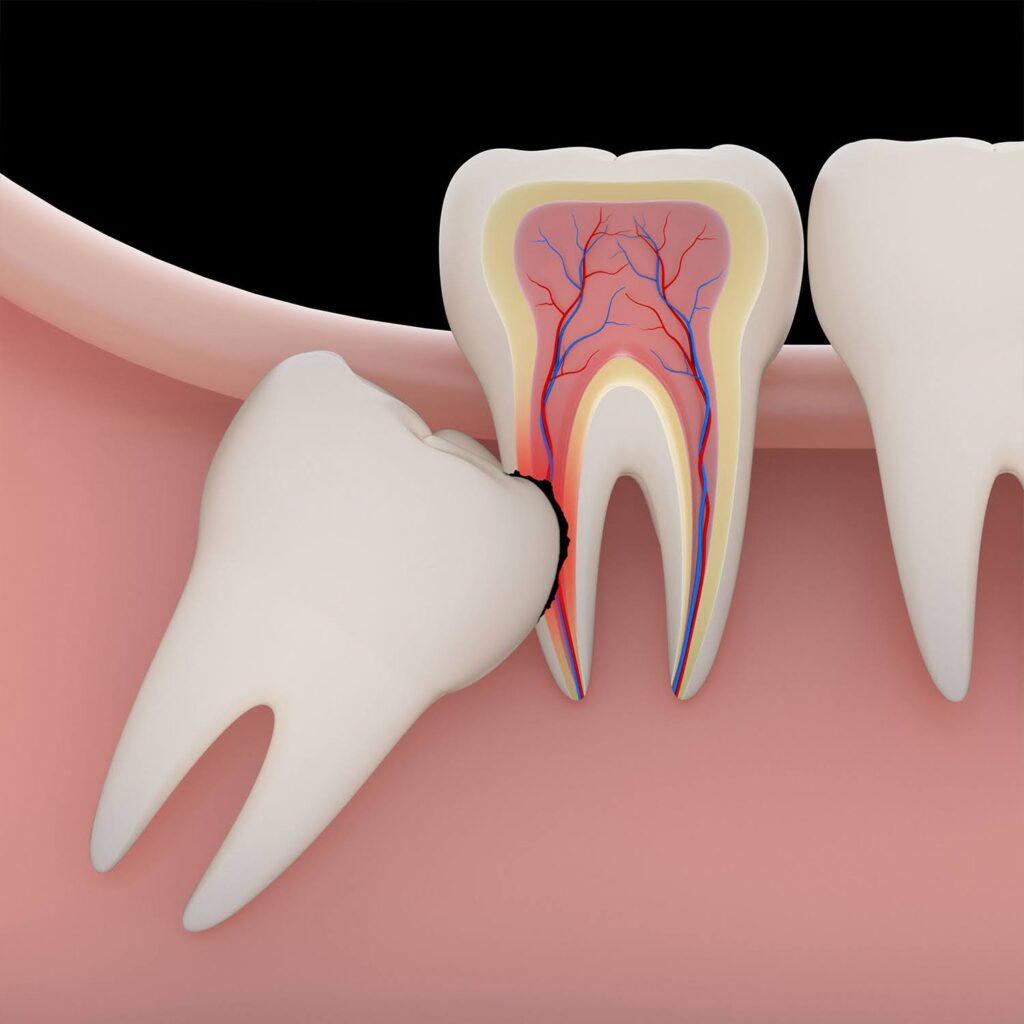 1. Understanding Wisdom Teeth: Why Do We Have Them?