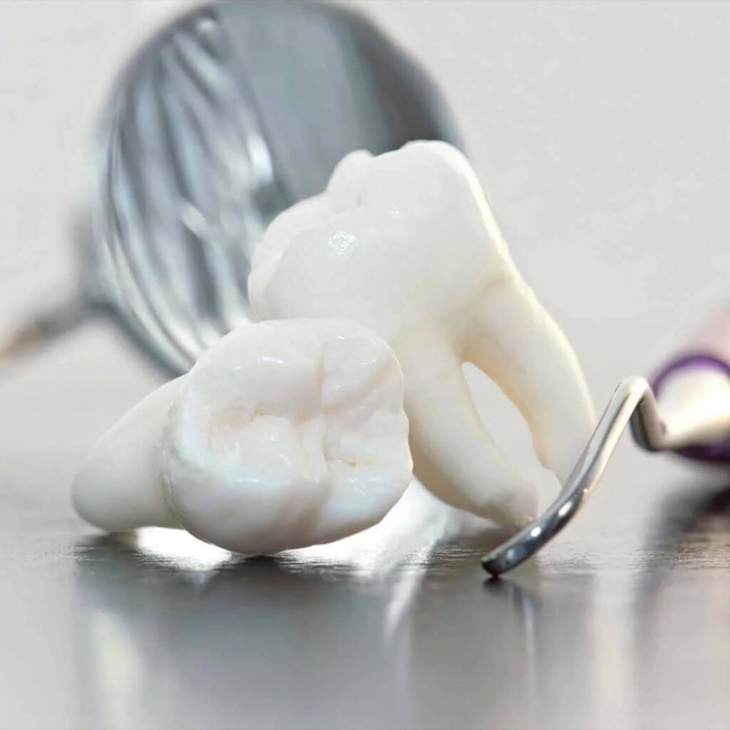 3. The Pros of Wisdom Teeth Removal: Why It Might Be the Right Choice