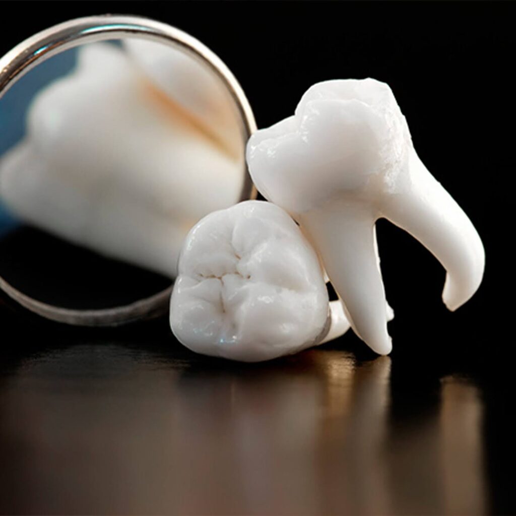 4. The Cons of Wisdom Teeth Removal: Weighing the Risks