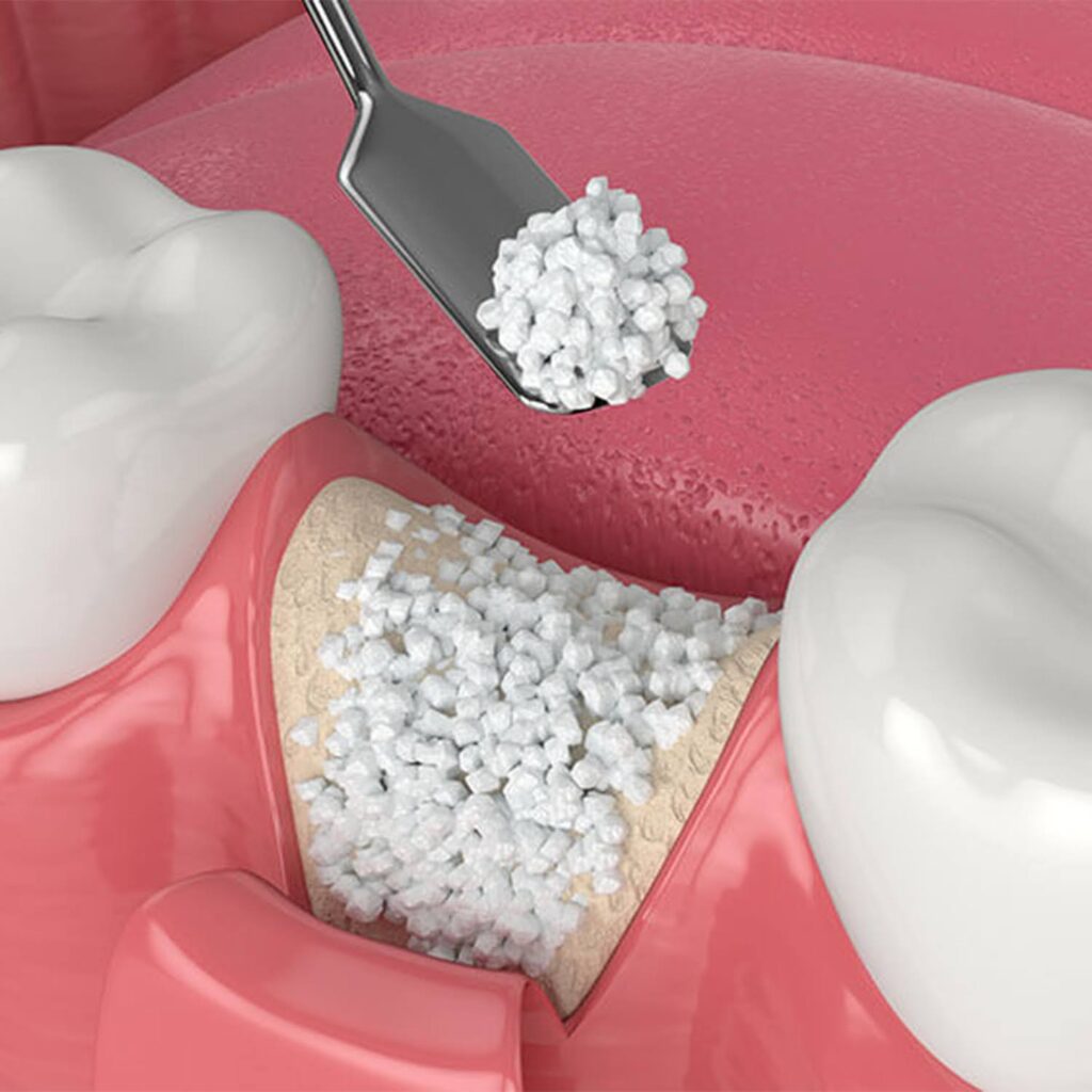 Bone-Grafting-vs-Dental-Implants-1