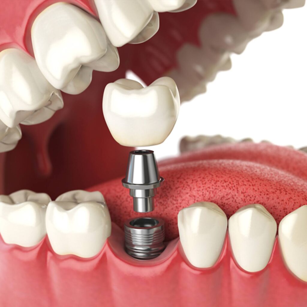 Bone-Grafting-vs-Dental-Implants-2