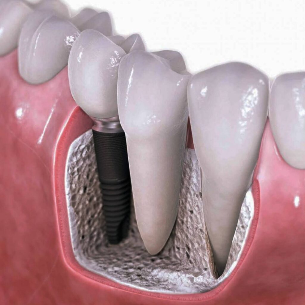 Bone-Grafting-vs-Dental-Implants-4