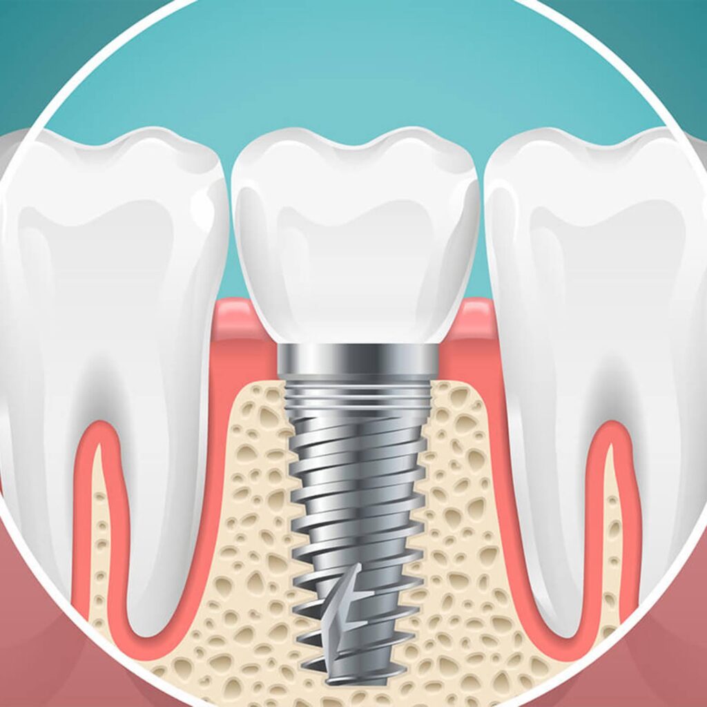 Bone-Grafting-vs-Dental-Implants-7