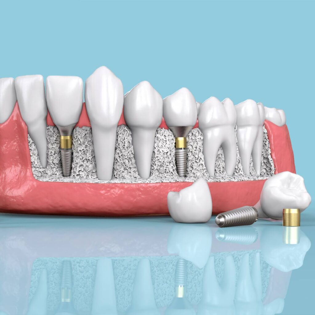 Bone-Grafting-vs-Dental-Implants-9