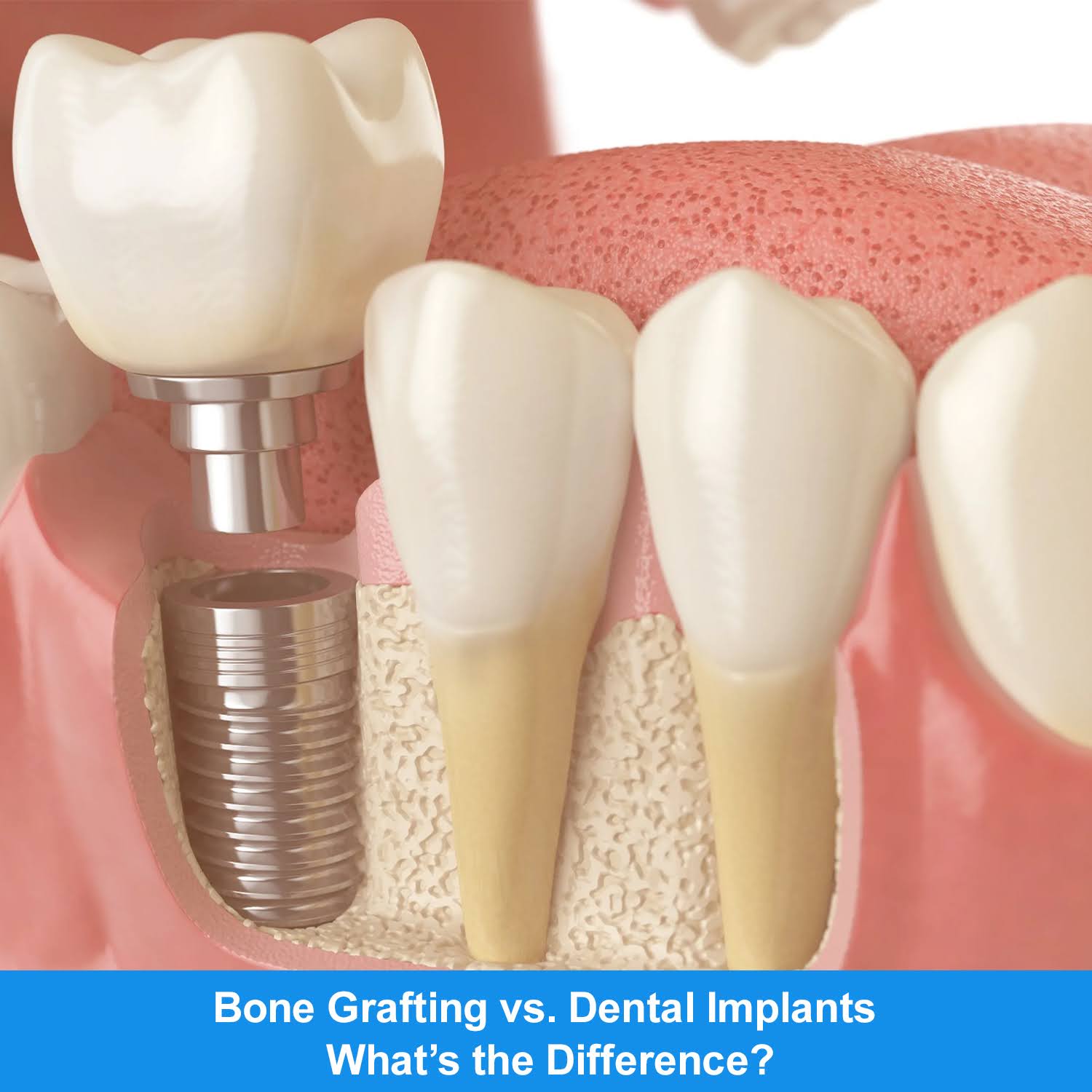 Bone Grafting vs. Dental Implants