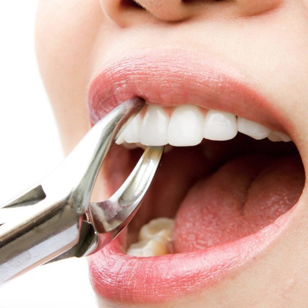 How-to-Care-for-Your-Mouth-After-Tooth-Removal-1