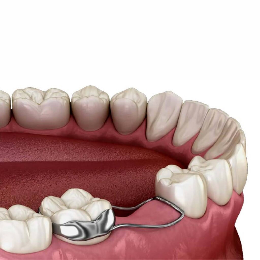 Ensuring Space for Future Teeth The Ultimate Guide to Space Maintainers-2