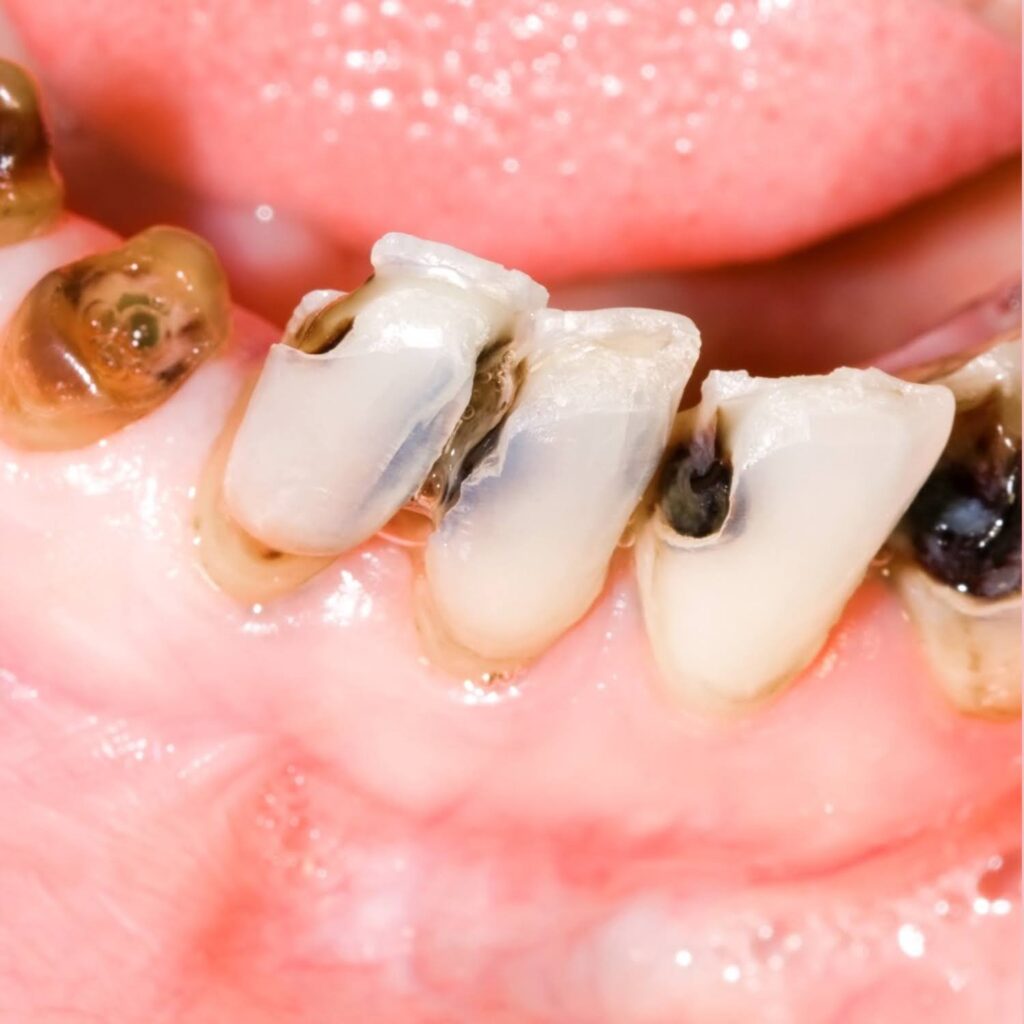  The Basics: What Causes Cavities in the First Place?