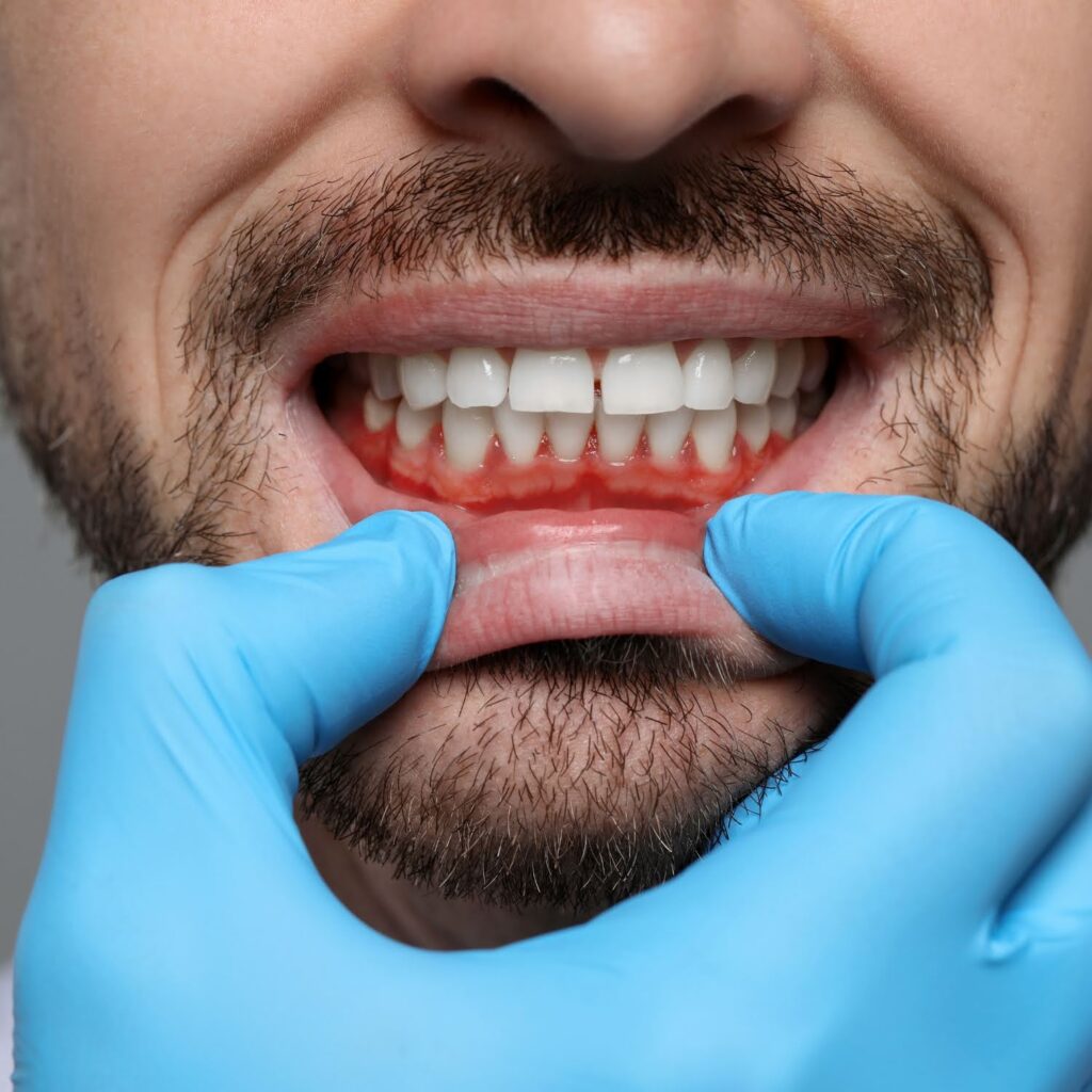 Don’t Let Gum Disease Ruin Your Summer Vacation 3